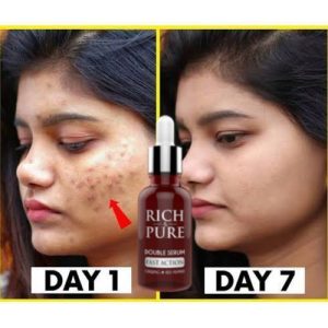 Rich & Pure Double Serum – Acne, Dark Spots & Sunburn Removal (30ml)